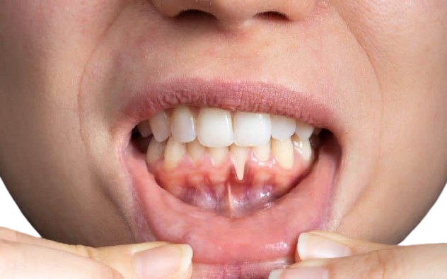Gum Disease Treatment